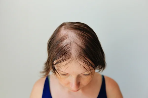 Image for 'How to Reverse Thinning Hair After Menopause - An Expert Guide' post by PatchMD - Vitamin Patches and Supplements, featuring a woman with thinning hair examining her reflection in the mirror.